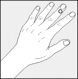 Acupunctuurpunt 15 bovenkant middelvinger pain zap bijnbestrijding pen